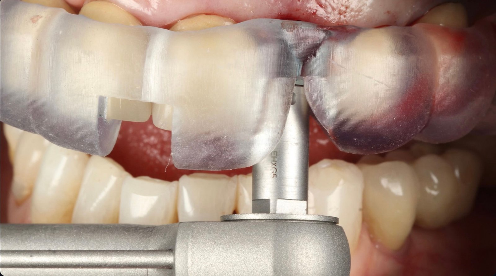 Prótesis sobre implantes - Caso 9